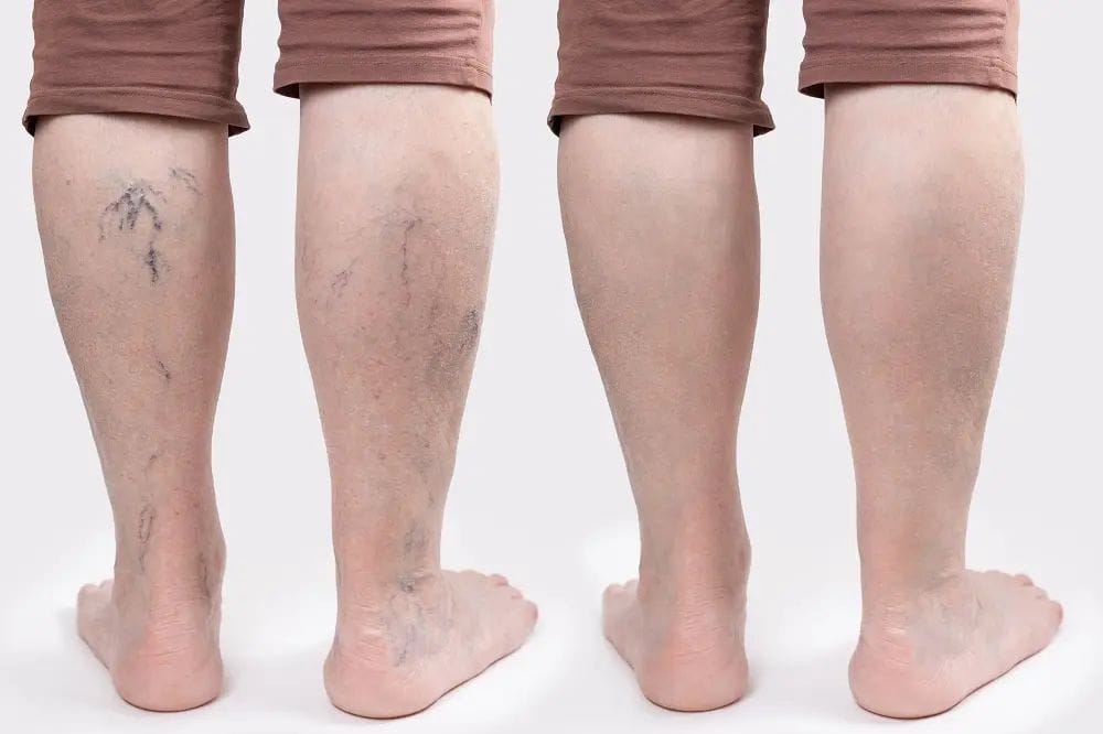 Recovery from Varicose Vein Surgery: How to Heal Faster ? When to Contact Your Doctor ?