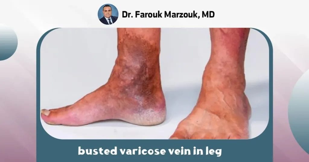 busted varicose vein in leg