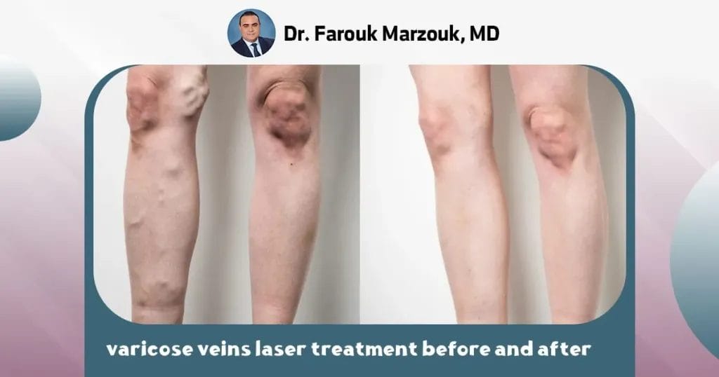 varicose veins laser treatment before and after