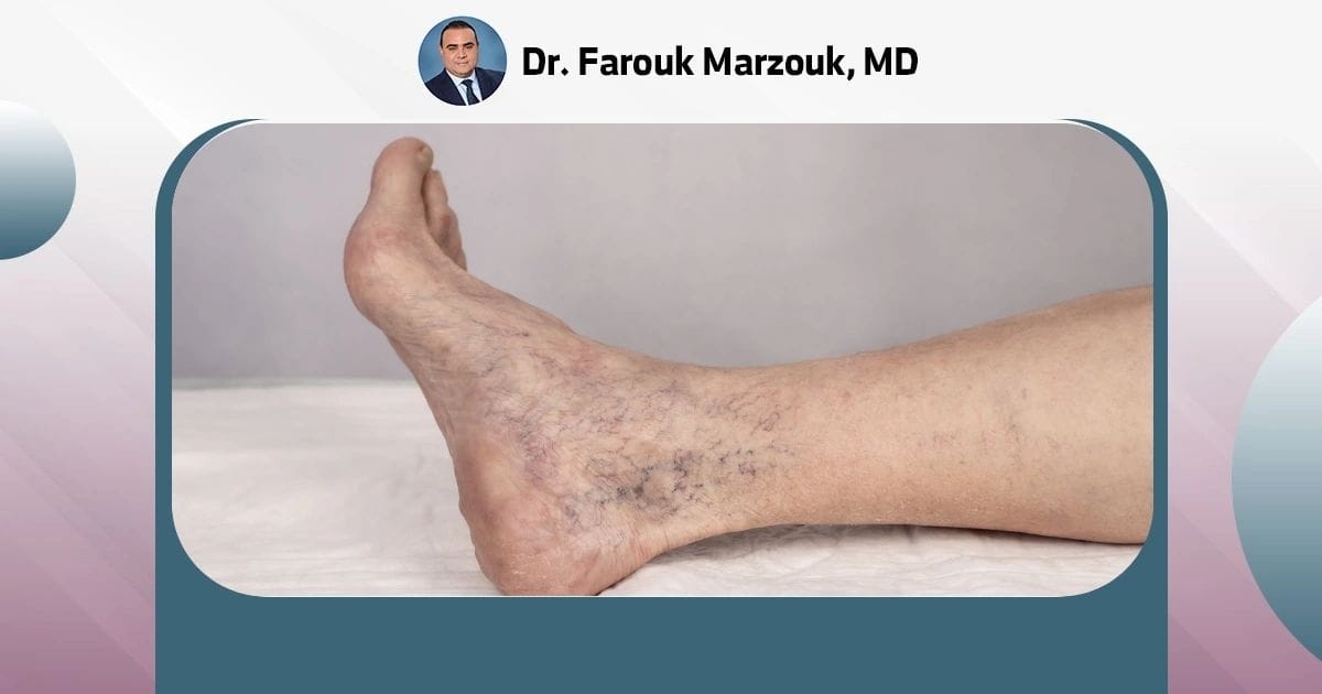 Can Varicose Veins Go Away With Weight Loss? Understand The Benefits