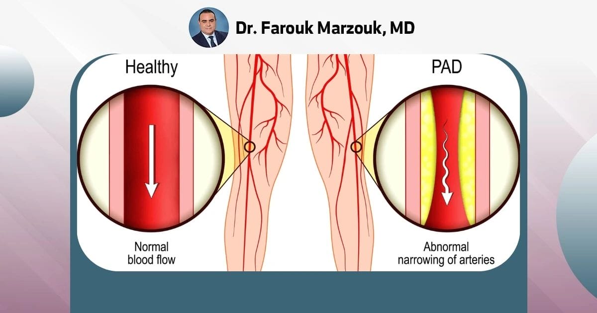 Peripheral Artery Disease (PAD) & Angioplasty