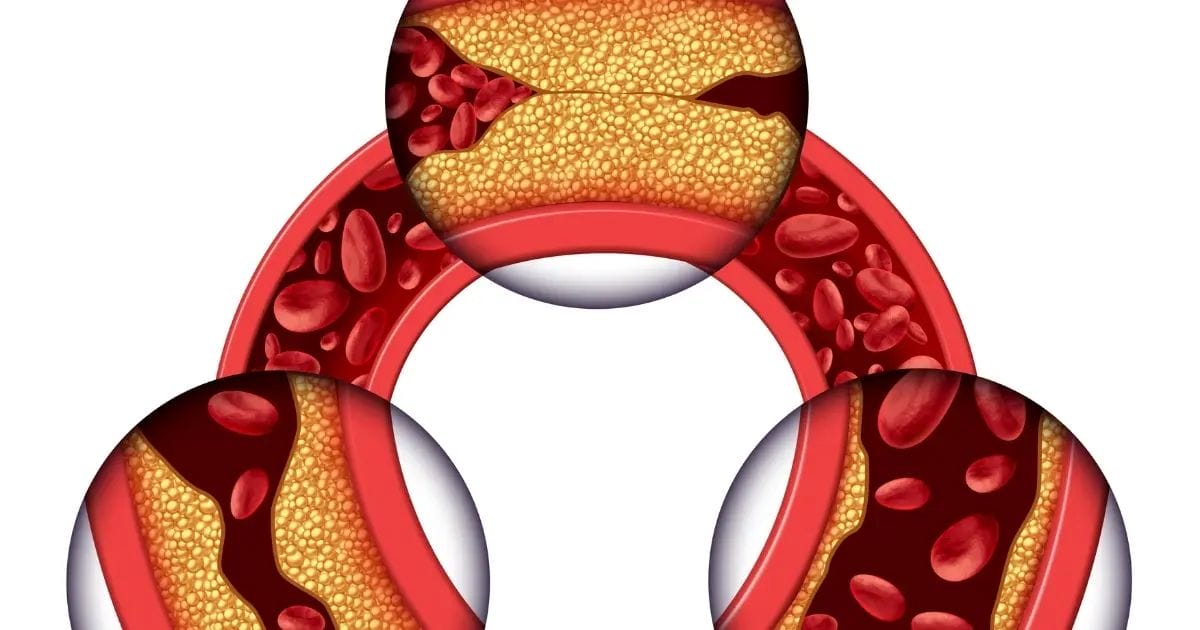 The Impaction of Vaping on Arteries