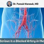 How Serious Is A Blocked Artery In The Leg: Is It Dangerous?