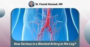 how serious is a blocked artery in the leg
