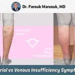 Arterial Vs Venous Insufficiency Symptoms: Arterial Vs Venous Disease