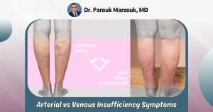 Arterial vs Venous Insufficiency Symptoms