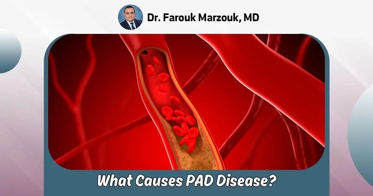 What Causes PAD