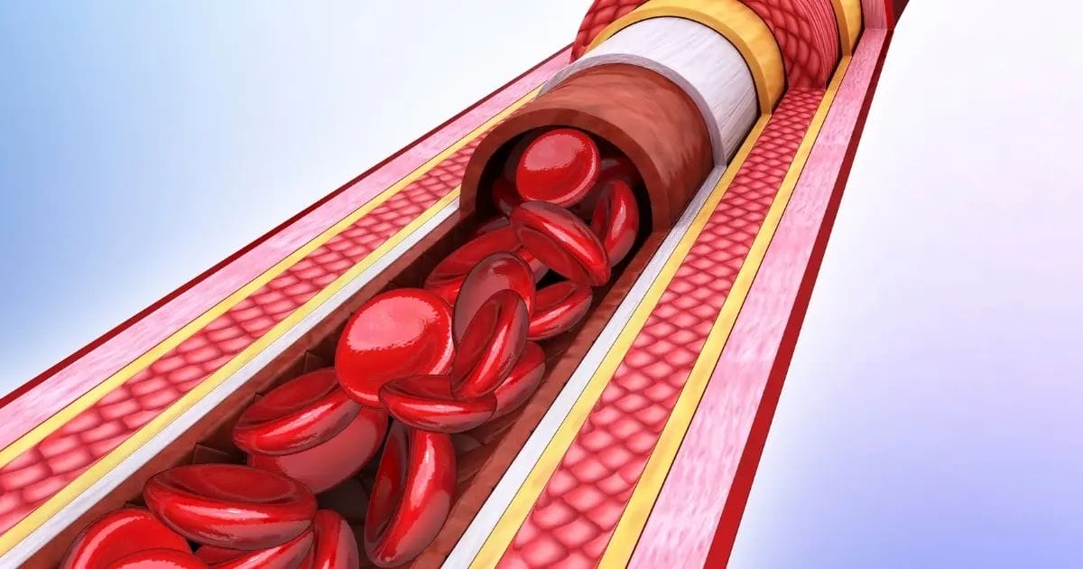 What Causes Peripheral Artery Disease In Legs